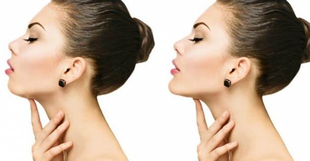 Jawline Çene Dolgusu Nedir? Nasıl Uygulanır ?