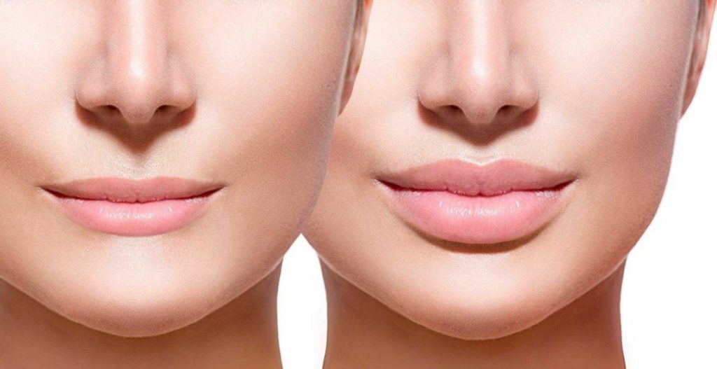 Lip Lift (Dudak Kaldırma) Estetiği Nedir? Lip Lift Nasıl Uygulanır?